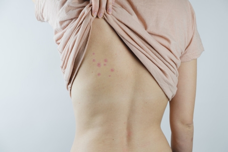 A person's back is shown with a cluster of red spots.